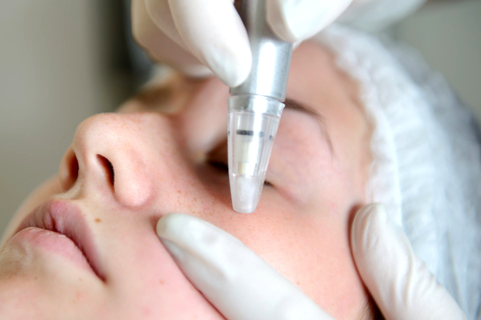 Microdermabrasion Behandlung Düsseldorf